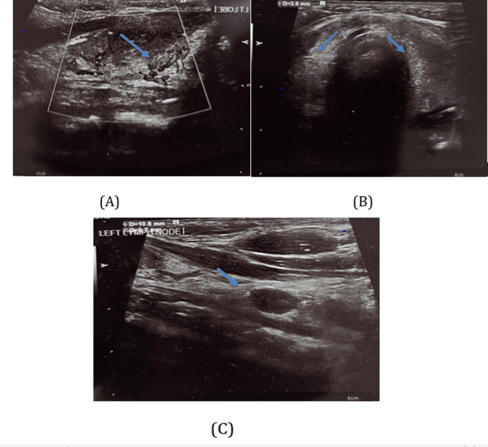 Dual Glucagon-Like Peptide-1 (GLP-1) and Glucose-Dependent Insulinotropic  Polypeptide (GIP) Receptor Agonist-Associated Thyroiditis: A Case Report of  Thyroid Dysfunction Following Tirzepatide Use