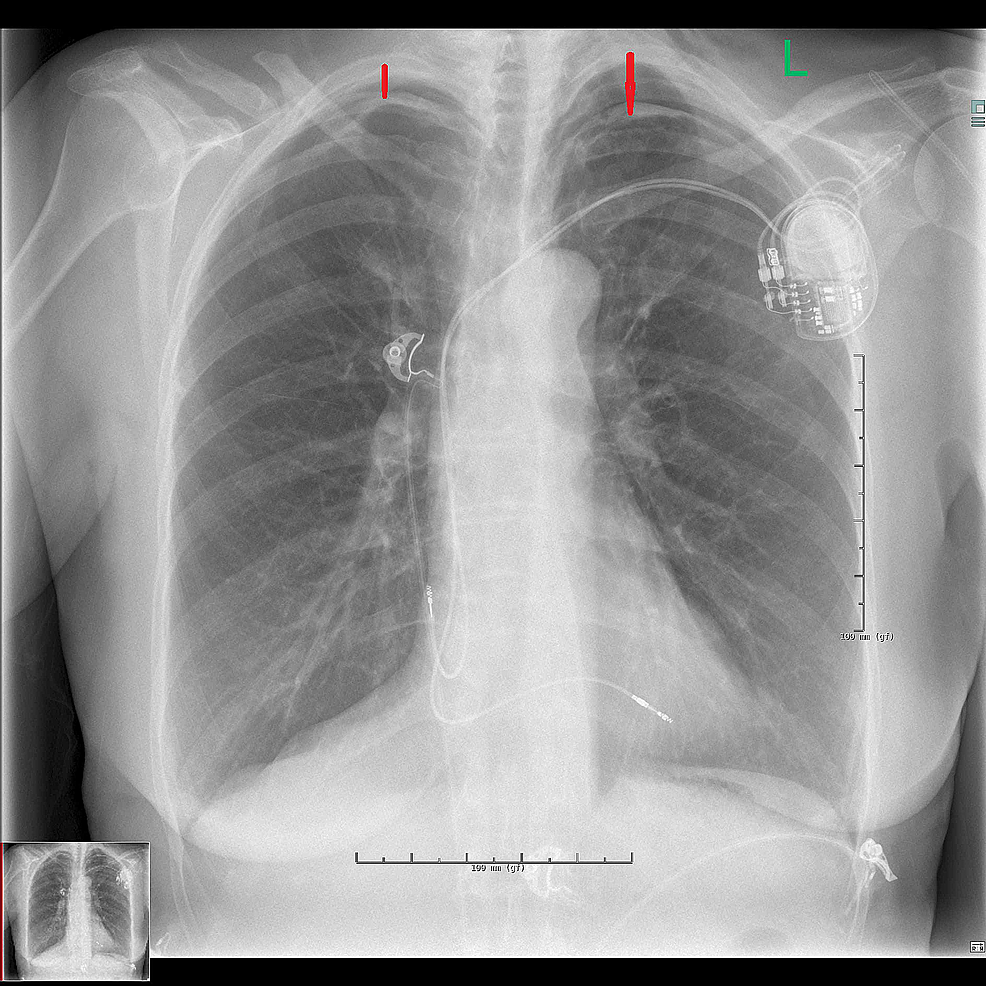 Apical Pneumothorax On Chest X Ray