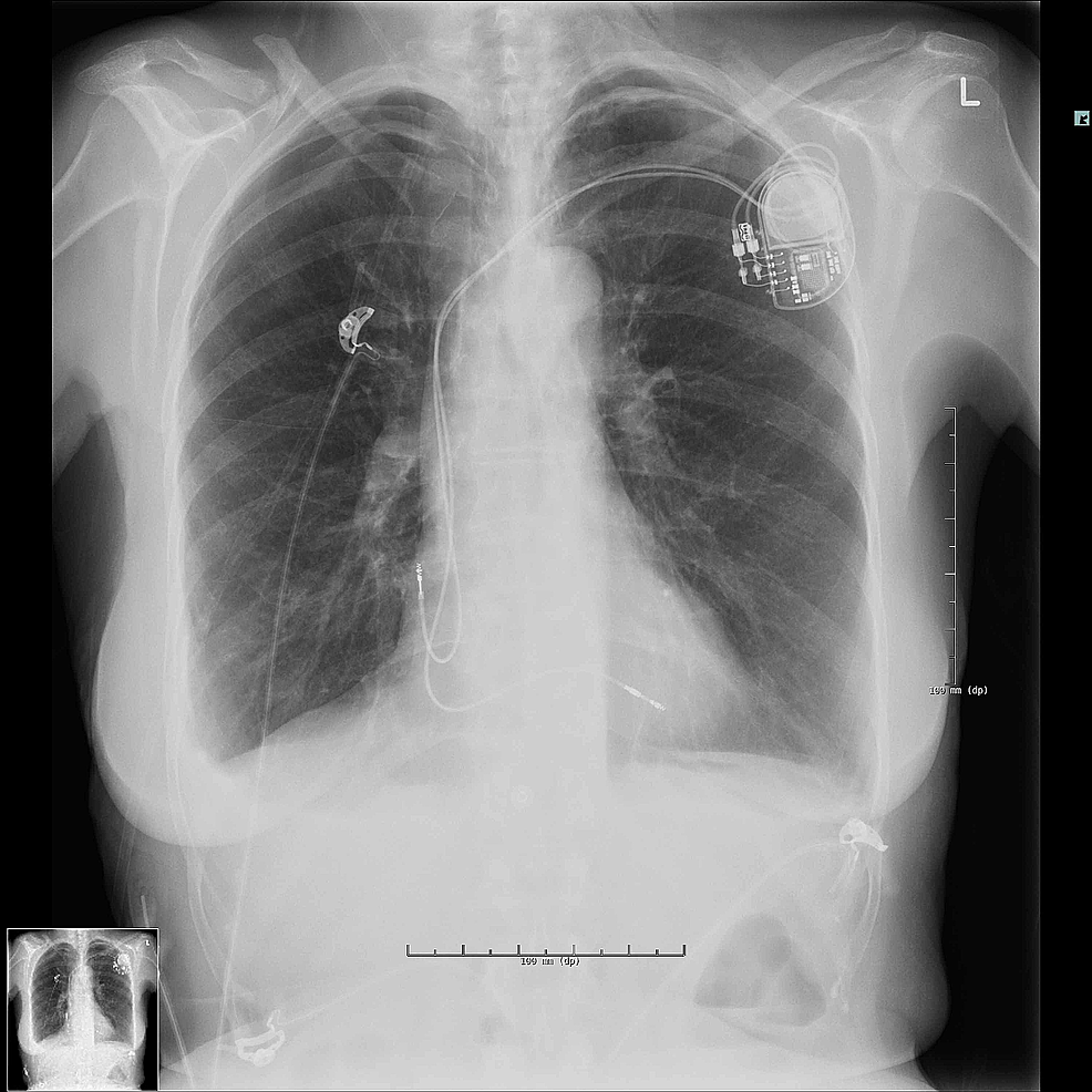 Cureus | Bilateral Pneumothorax Complicating Pacemaker Implantation ...