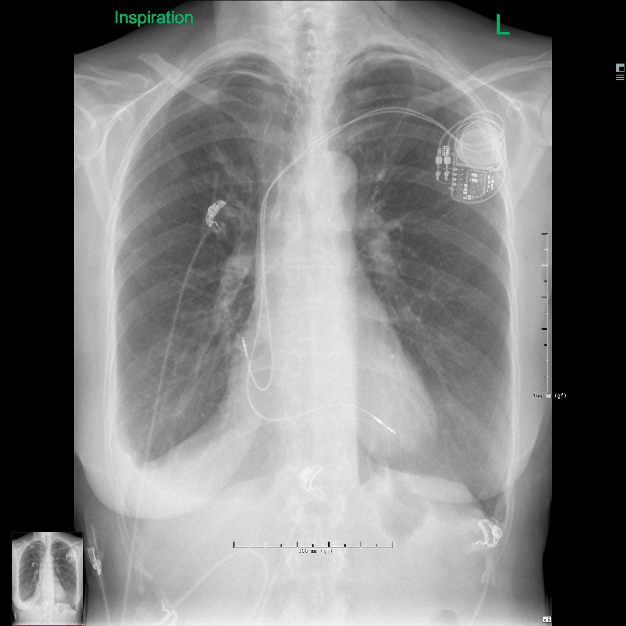 Cureus | Bilateral Pneumothorax Complicating Pacemaker Implantation ...