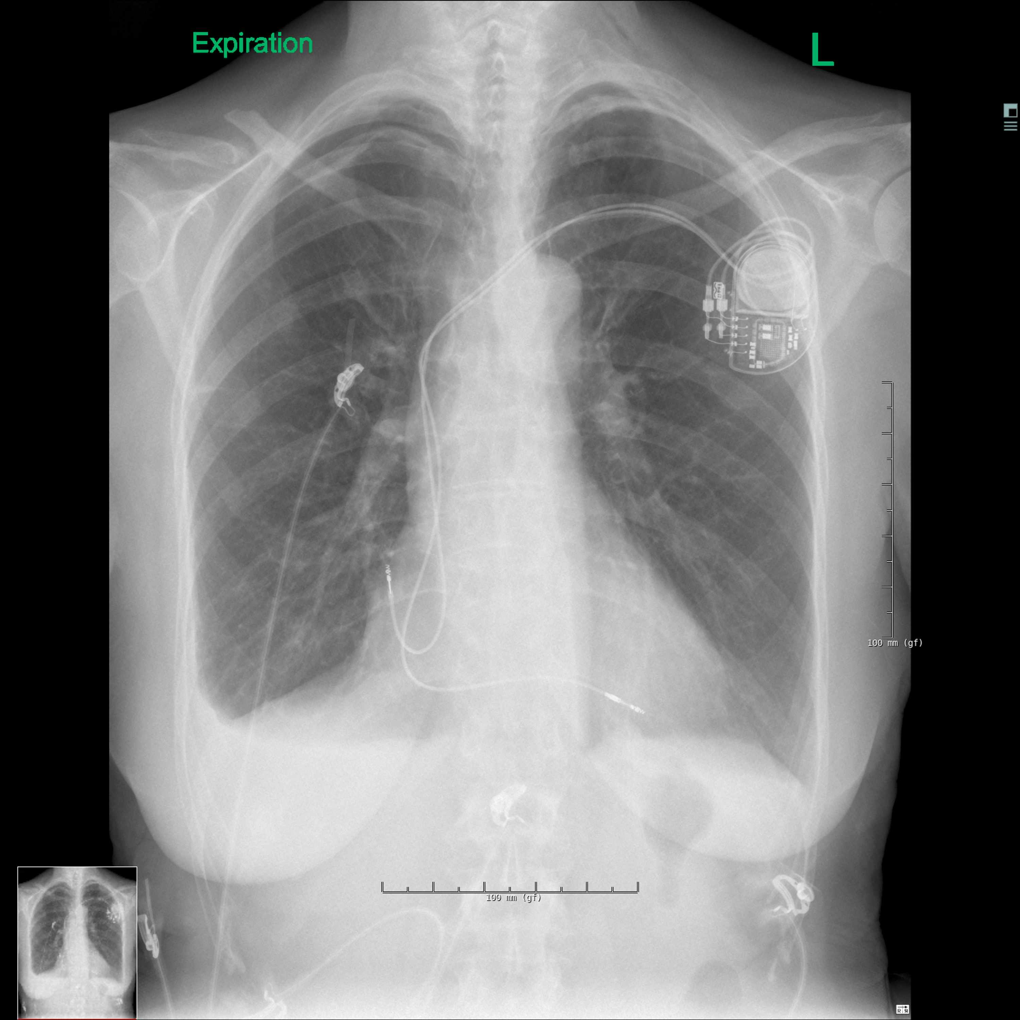 Cureus | Bilateral Pneumothorax Complicating Pacemaker Implantation ...