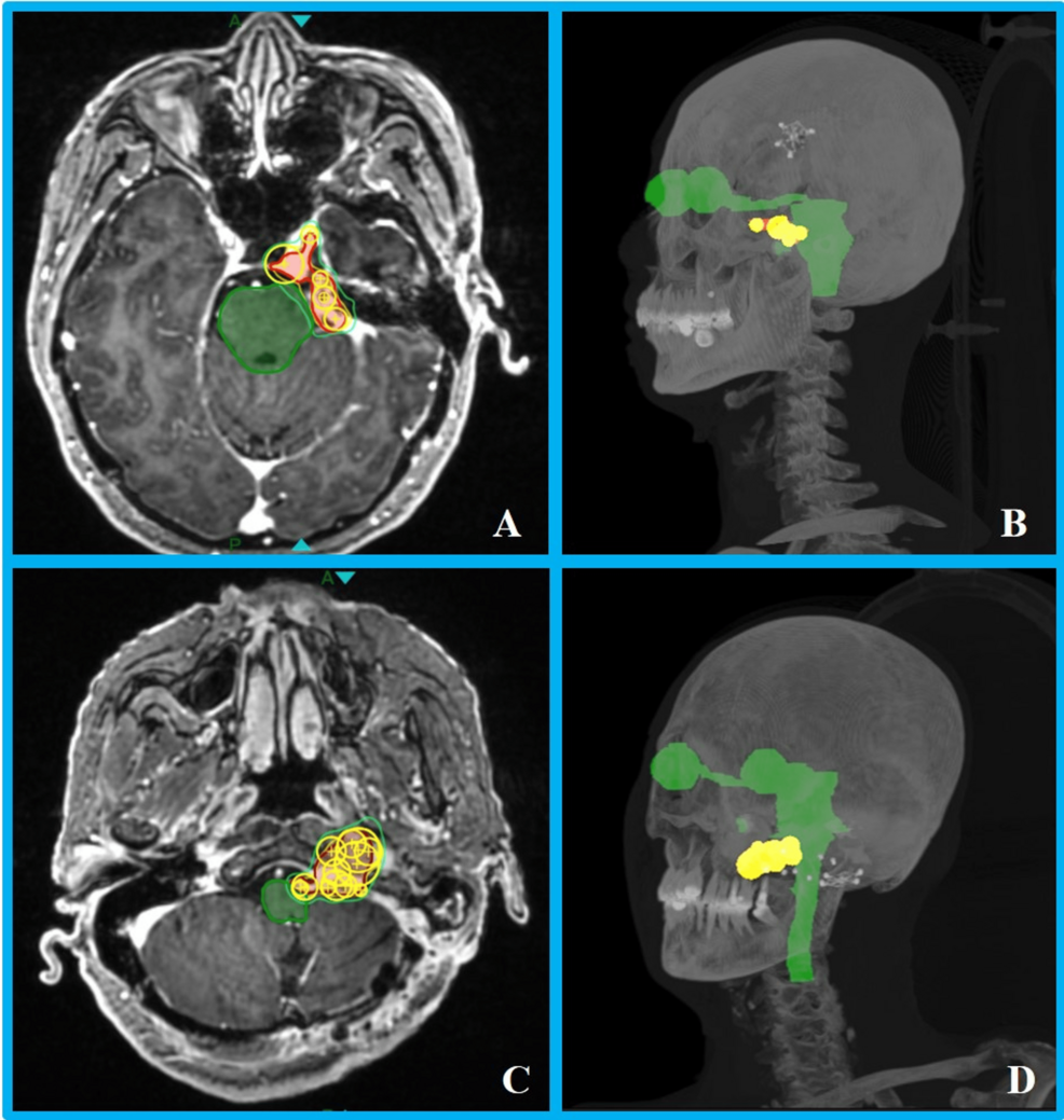 Zap-X Radiosurgery for Skull Base Meningiomas: A Long-Term