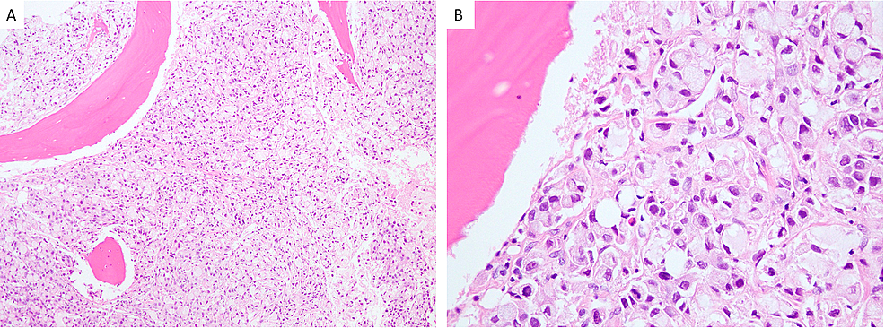 Cureus | Metastatic Gastric Signet Ring Cell Adenocarcinoma