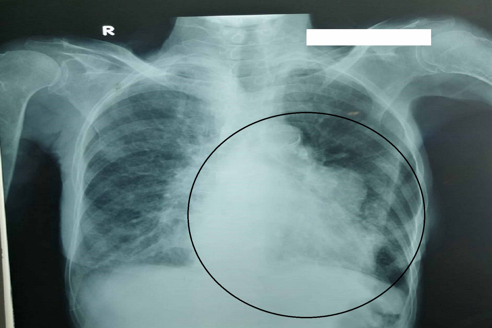 Cureus Pericardial Tumor, a Rare Manifestation of Sjogren’s Syndrome
