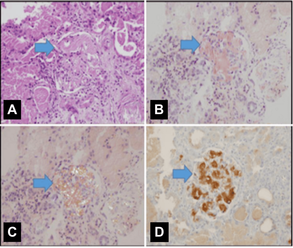 Histopathological-and-immunohistochemical-evidence-of-glomerular-AA-amyloid-deposition-in-a-kidney-biopsy