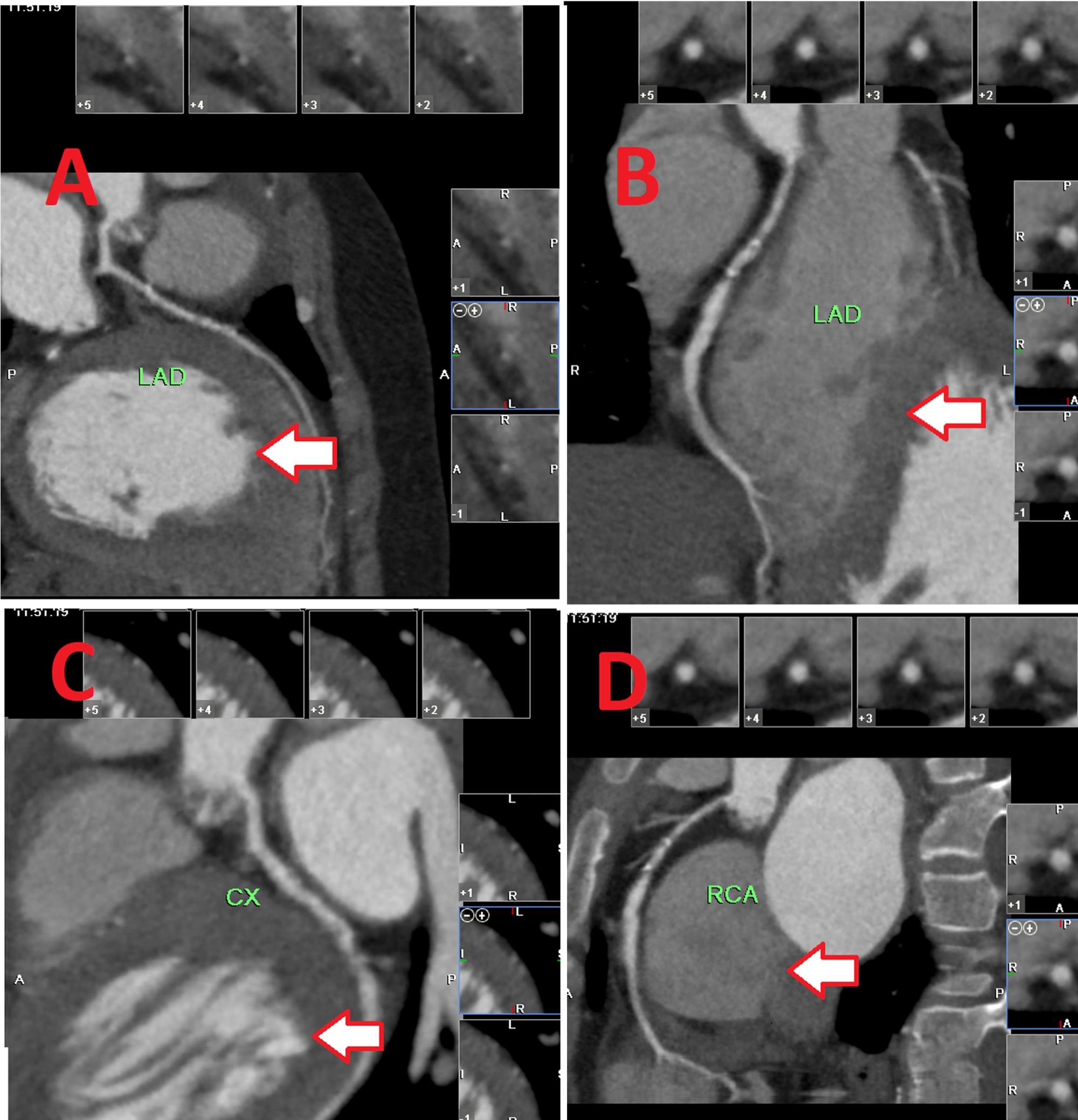 Cureus A Case Of Premature Triple Vessel Coronary Artery Disease And 