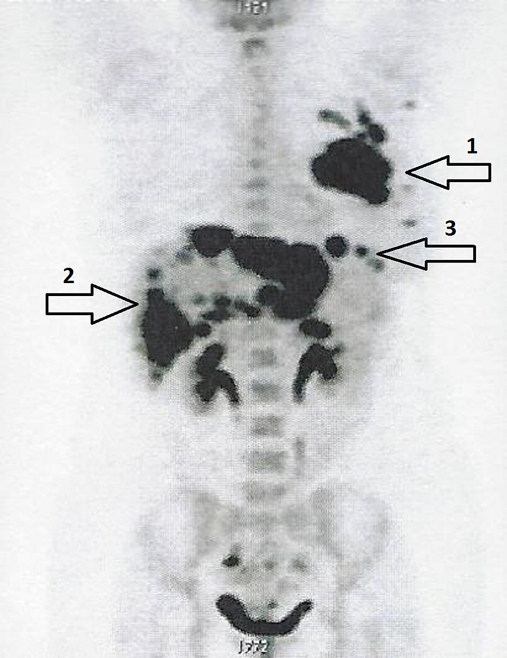 Whole-body-(18F)-FDG-PET-CT-scan-showing-a-77-mm-x-55-mm-primary-tumor-in-the-left-breast-(arrow-1),-multiple-widespread-liver-masses-(arrow-2),-and-an-upper-left-nodular-abdominal-lesion-(arrow-3).