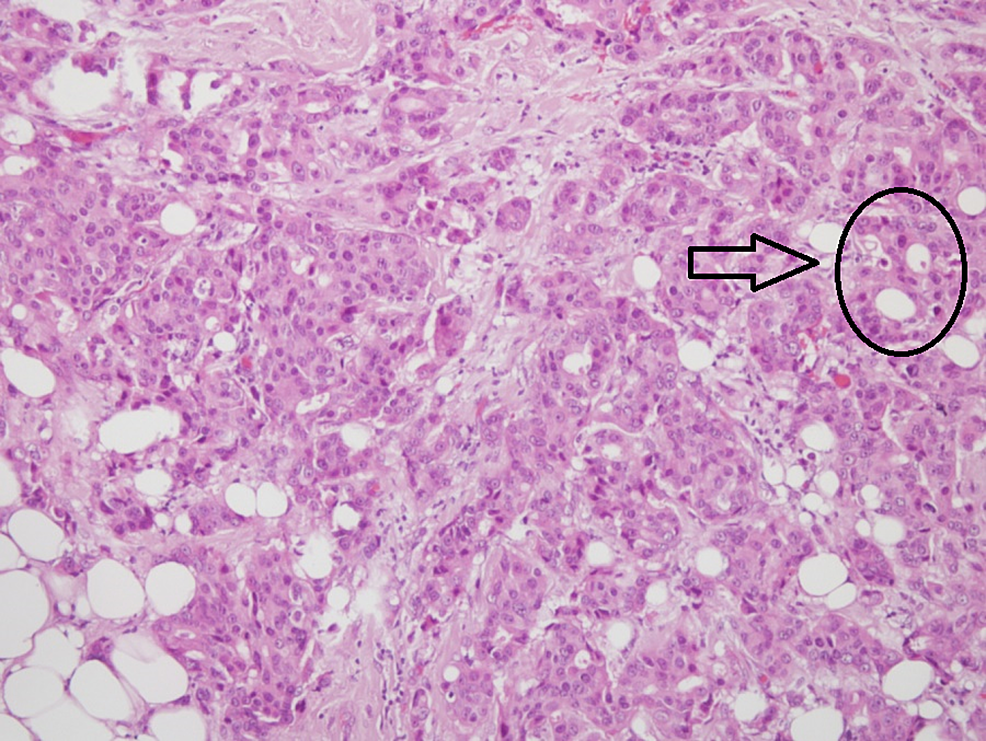 Histopathological-examination-showing-a-solid-mass-and-gland-forming-atypical-epithelial-cells-indicative-of-nuclear-grade-2-invasive-ductal-carcinoma-(x100)