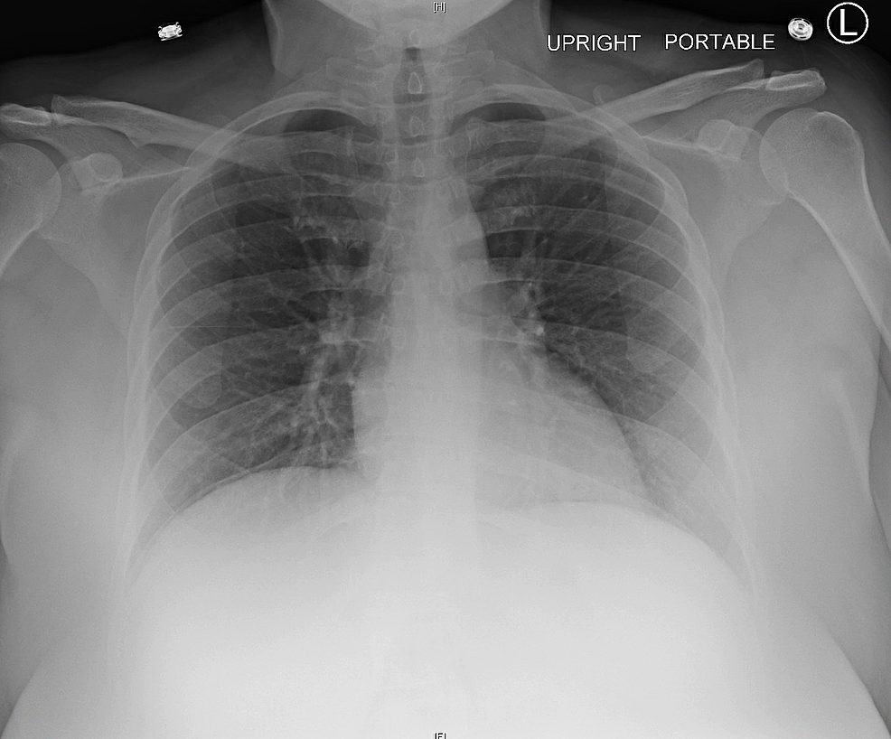 Pulmonary Embolism X Ray Google Search Chest Pathology