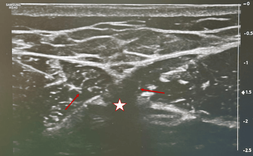 Red-arrow:-needle-tip;-star:-shadow-acoustic-xiphoid-appendix Red-arrow:-needle-tip;-star:-shadow-acoustic-xiphoid-appendix