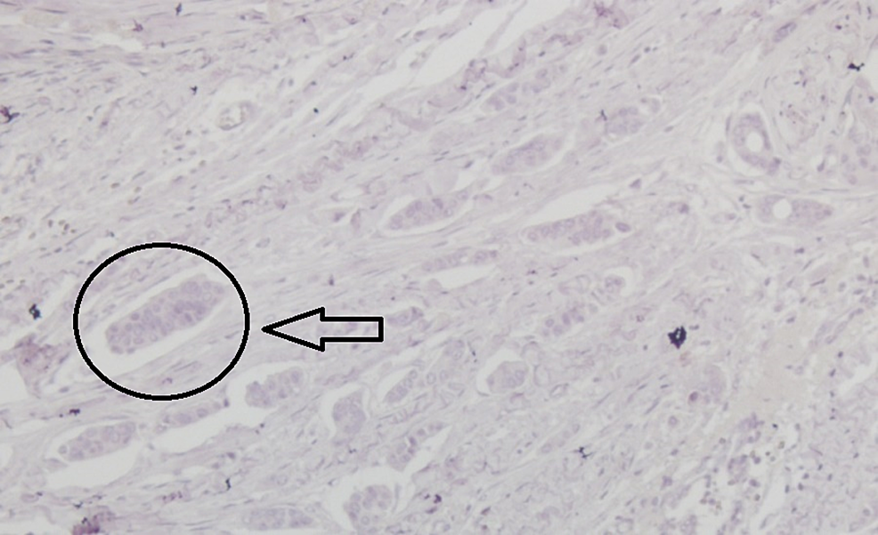 Immunohistochemical-examination-of-the-tumor-showing-negativity-for-human-epidermal-growth-factor-2-receptors-(x200)