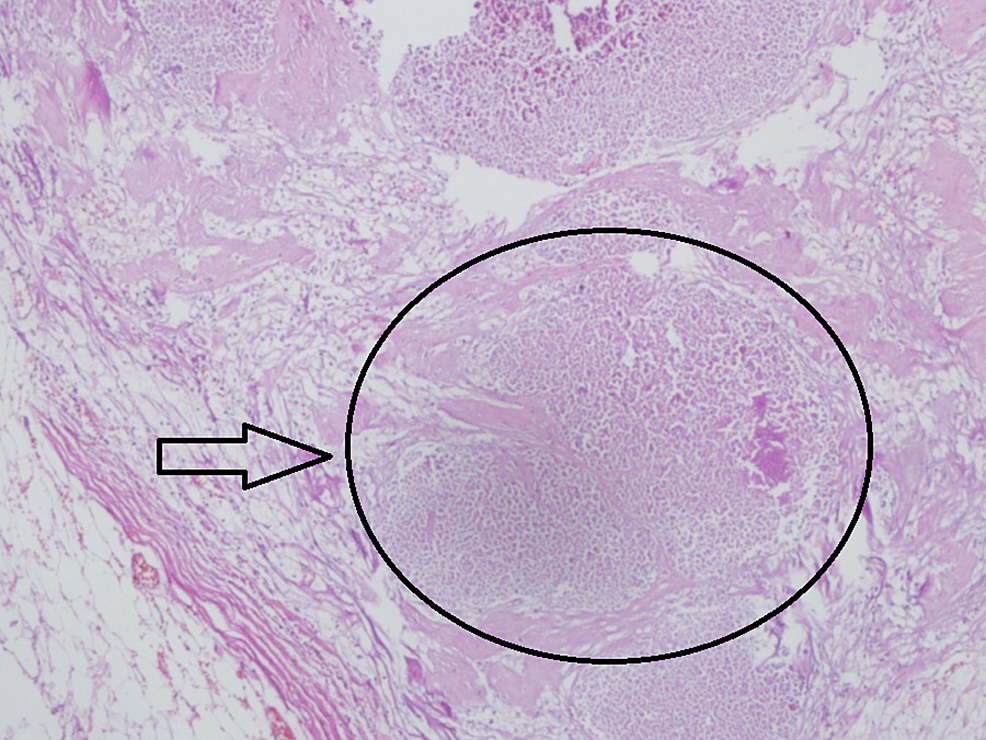 Lymph-node-sample-of-the-metastatic-axillar-lymph-node-showing-totally-necrotized-tissue-with-no-live-tumor-cells-(x100)
