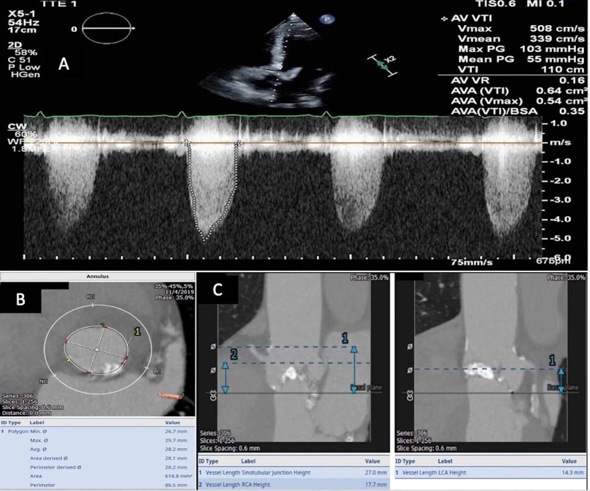 Cureus Acute Ostial Right Coronary Artery Occlusion During Valve