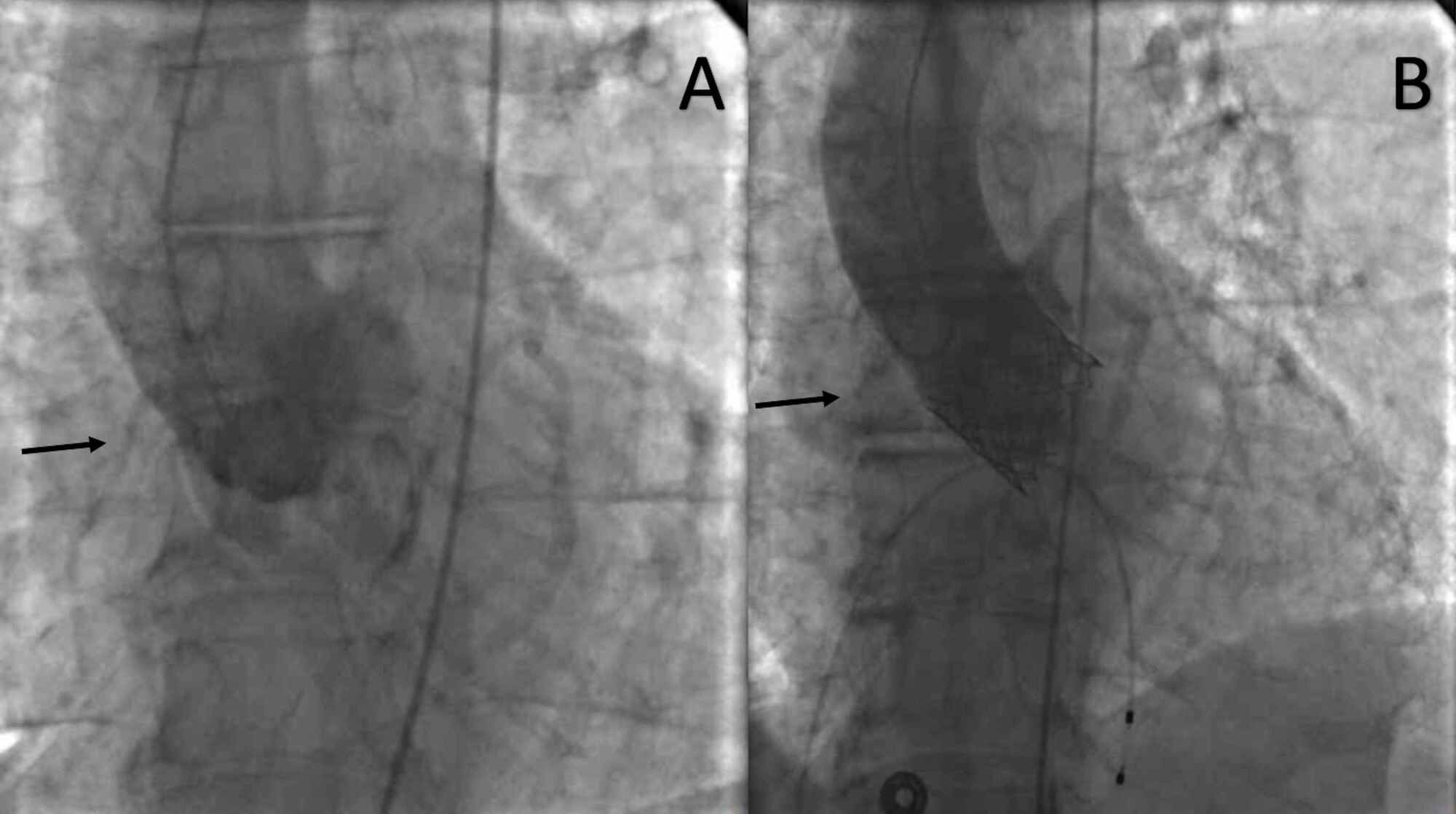 Cureus Acute Ostial Right Coronary Artery Occlusion During Valve