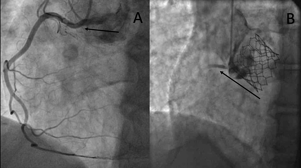 Cureus Acute Ostial Right Coronary Artery Occlusion During Valve