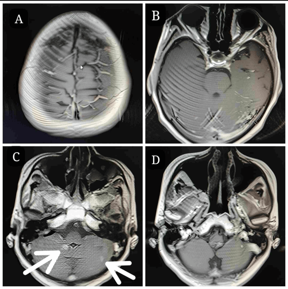 Contrast-enhanced-MRI-of-the-brain-at-the-eighth-month-follow-up-with-almost-complete-regression-(A,-B,-and-D)-of-intracranial-metastatic-deposits-of-the-primary-left-breast-invasive-ductal-carcinoma-and-residual-deposits-(C).
