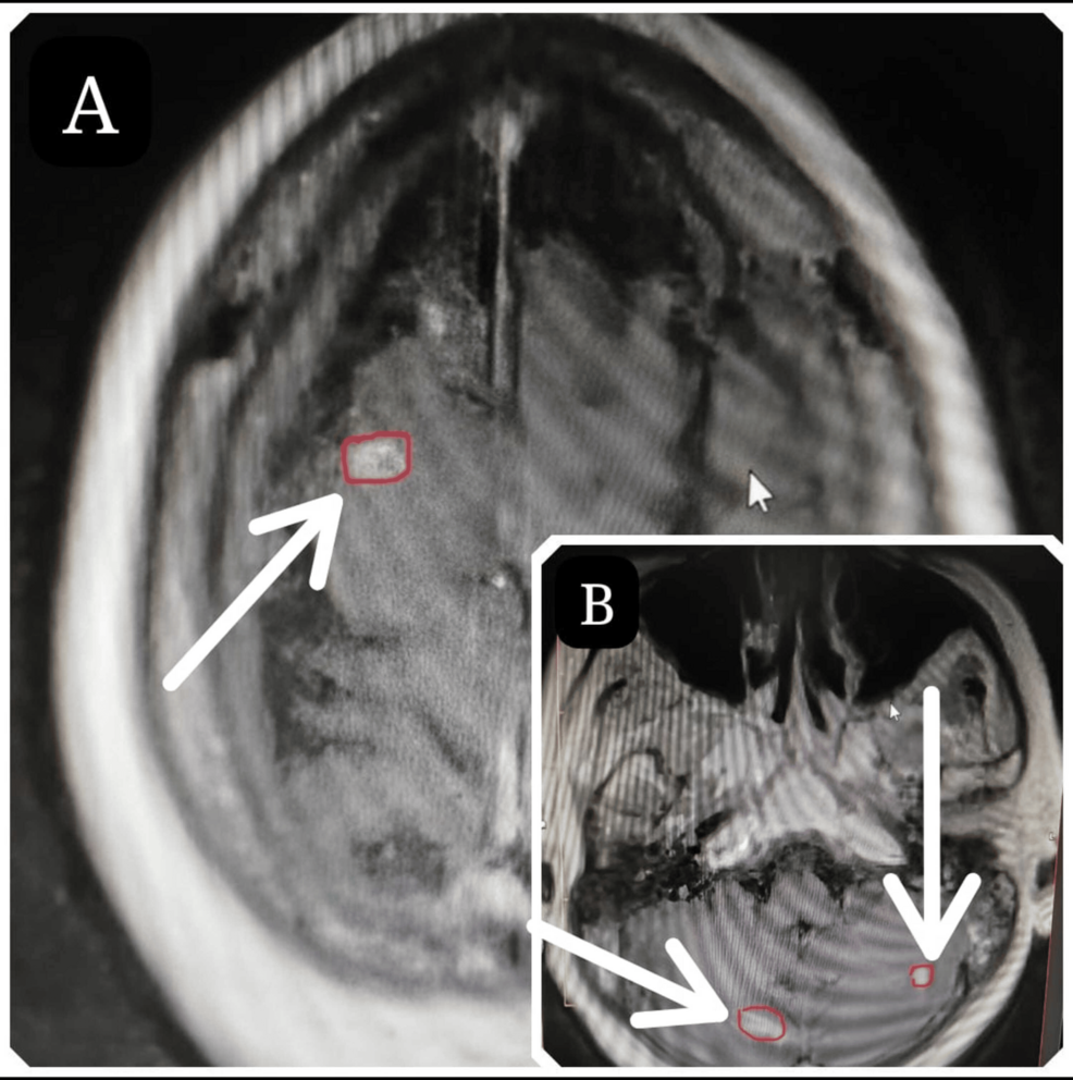 Contrast-enhanced-MRI-of-the-brain-at-the-fourth-month-of-follow-up-showing-right-frontal-(A)-and-bilateral-cerebellar-(B)-metastatic-deposits-(white-arrows)-from-the-primary-left-breast-invasive-ductal-carcinoma.