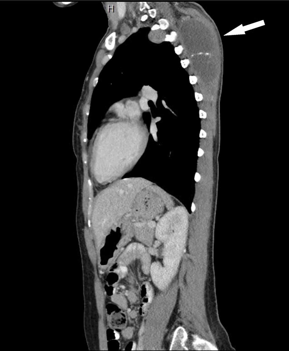 Cureus Tension Pneumothorax Is it or Pazopanib?