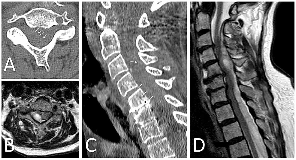 Cureus | Spontaneous Spinal Epidural Hematoma Associated With Apixaban ...