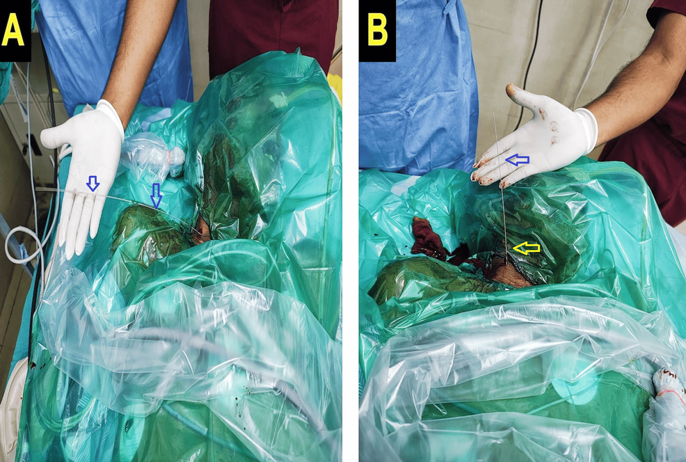 Laterally-directed-external-portion-of-the-guidewire-pointing-to-the-right-(same-side)-shoulder-for-malposition-(A),-aligned-cephalad-along-the-midline-when-properly-placed-after-repositioning-(B). Laterally-directed-external-portion-of-the-guidewire-pointing-to-the-right-(same-side)-shoulder-for-malposition-(A),-aligned-cephalad-along-the-midline-when-properly-placed-after-repositioning-(B).
