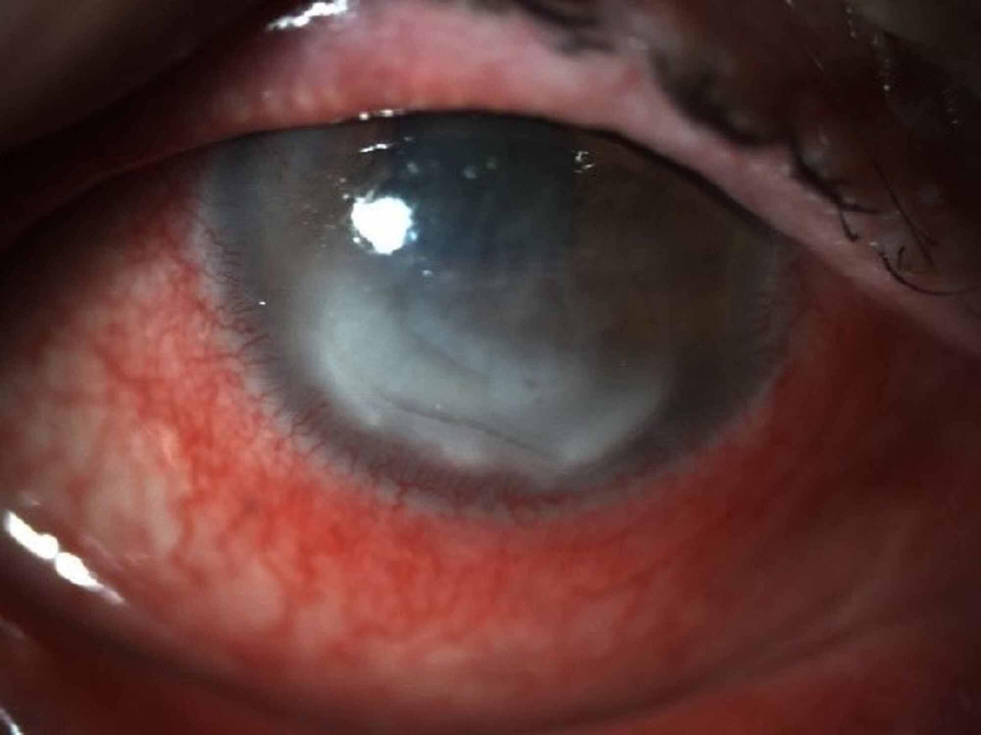 Cureus | Matrix Regenerating Agent (RGTA) in a Neurotrophic Corneal Ulcer