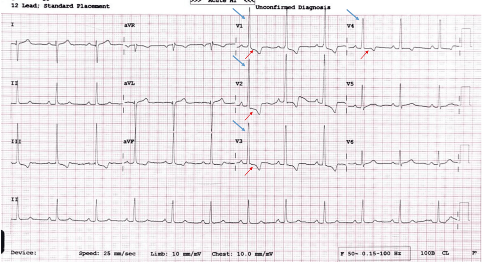 Ventricule droit à double chambre isolé chez un patient adulte : du diagnostic à la prise en charge