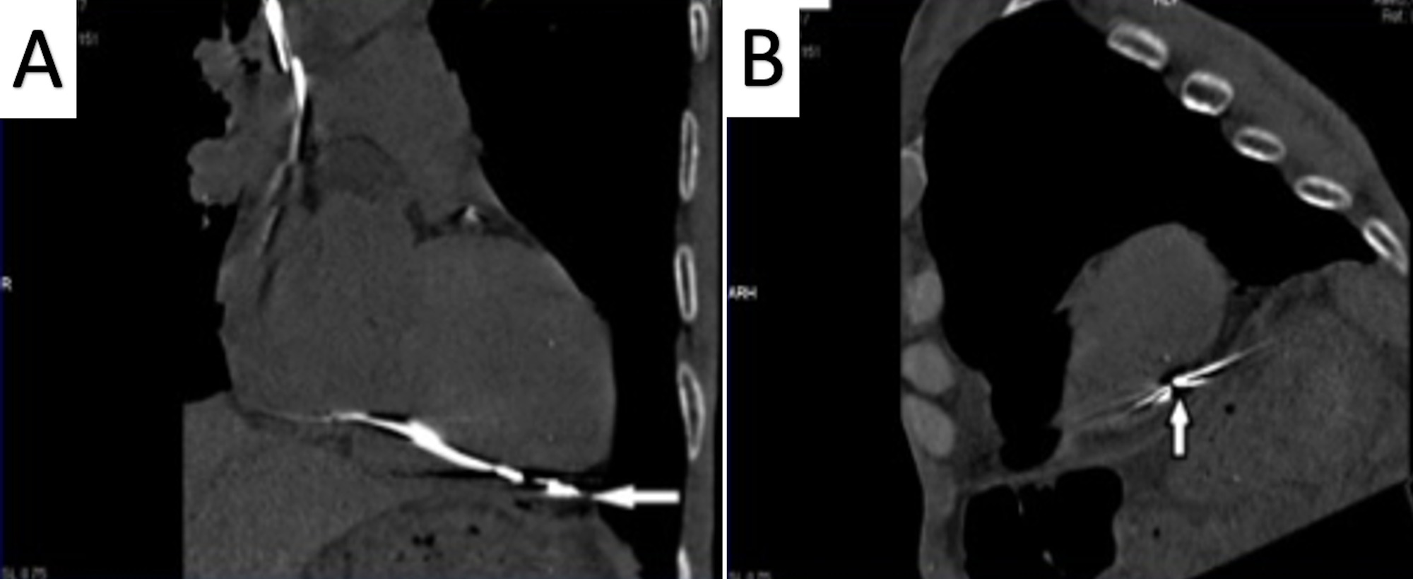 Cureus | An Interesting Case of Acute Asymptomatic Lead Perforation of ...