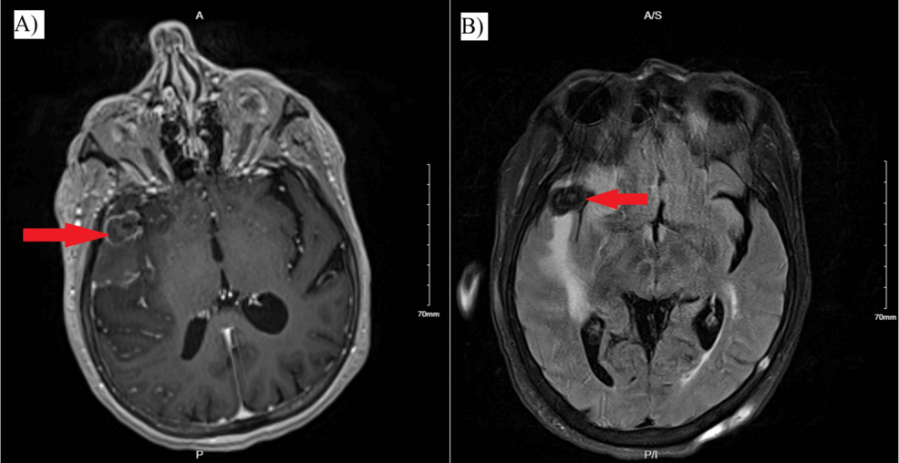 Thrombosed Middle Cerebral Artery Bifurcation Aneurysm Presenting