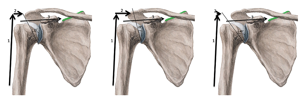 Cureus | The Critical Shoulder Angle as a Diagnostic Measure for ...