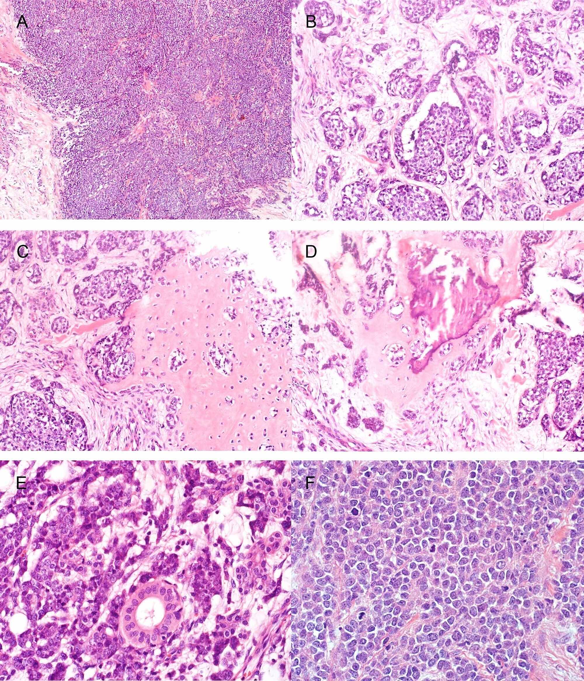 Cureus | Adamantinoma-Like Ewing Sarcoma of the Parotid Gland: Report ...