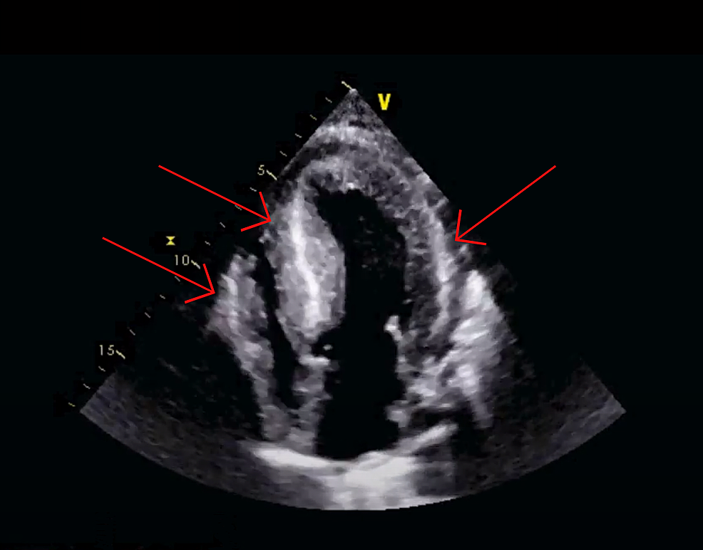 A Preprocedure Echocardiography Showing Ventricular A - vrogue.co