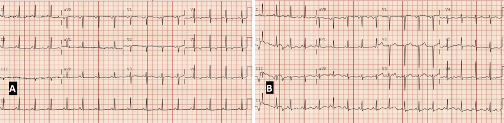 Baseline-and-admission-electrocardiograms-demonstrating-evolving-cardiopulmonary-stress-(paper-speed:-25-mm/s,-calibration:-10-mm/mV). Baseline-and-admission-electrocardiograms-demonstrating-evolving-cardiopulmonary-stress-(paper-speed:-25-mm/s,-calibration:-10-mm/mV).