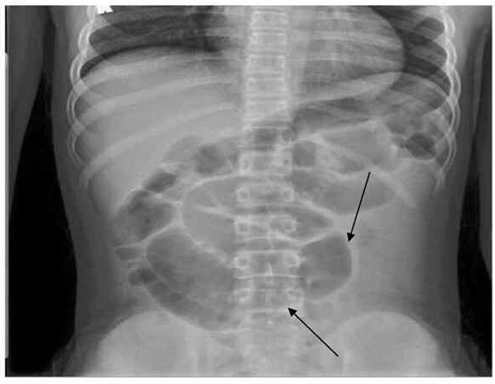 Cureus | COVID-19 Infection in a Child Presenting With Functional ...