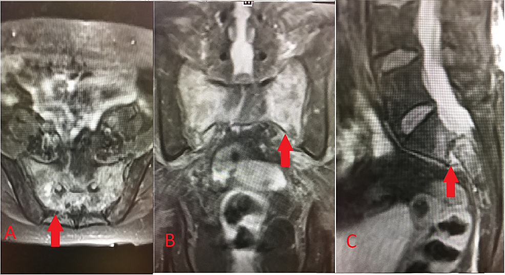 Cureus, Congenital Pseudoarthrosis of Tibia With Anterolateral Bowing  Treated With Ilizarov Ring Fixator: A Case Report