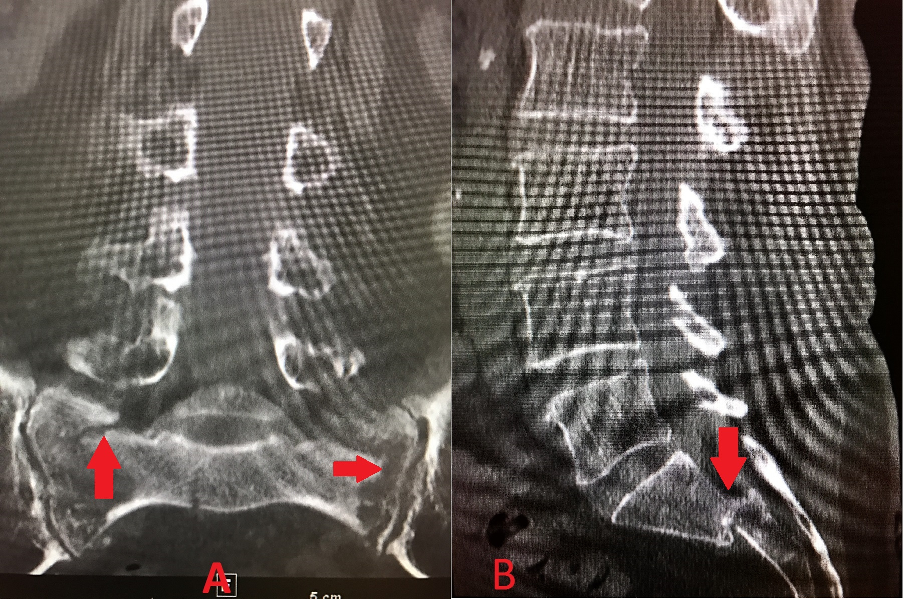 Cureus Combined Sacroplasty and Iliosacral Fixation Using Triangular