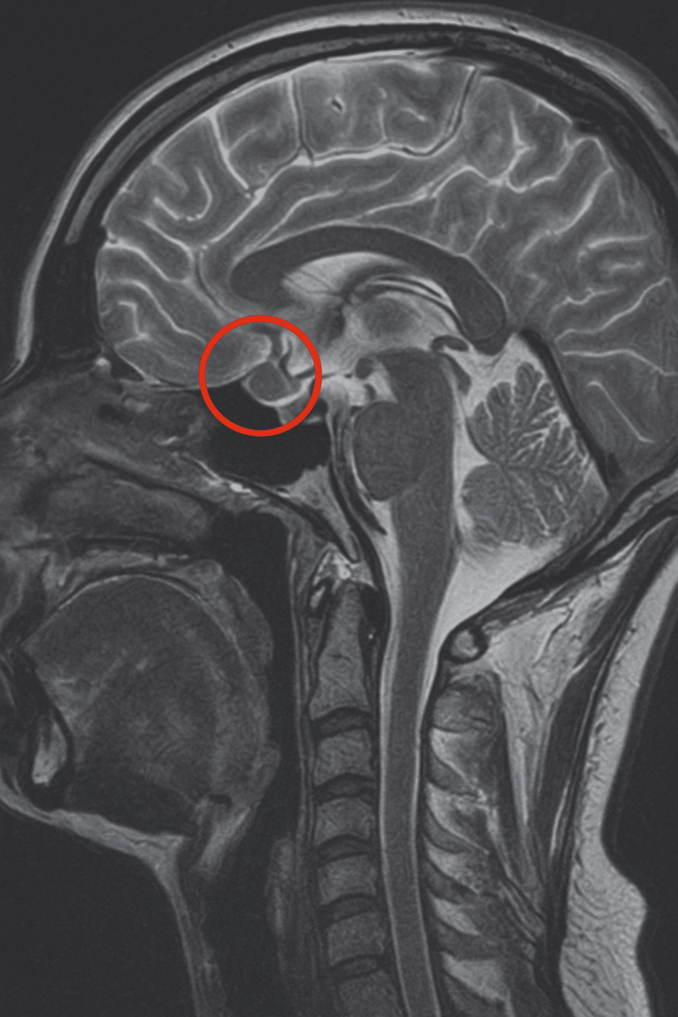 T1-weighted-sagittal-MRI-scan-showing-a-corticotroph-pituitary-microadenoma-(4-×-3-mm)-circled-in-red
