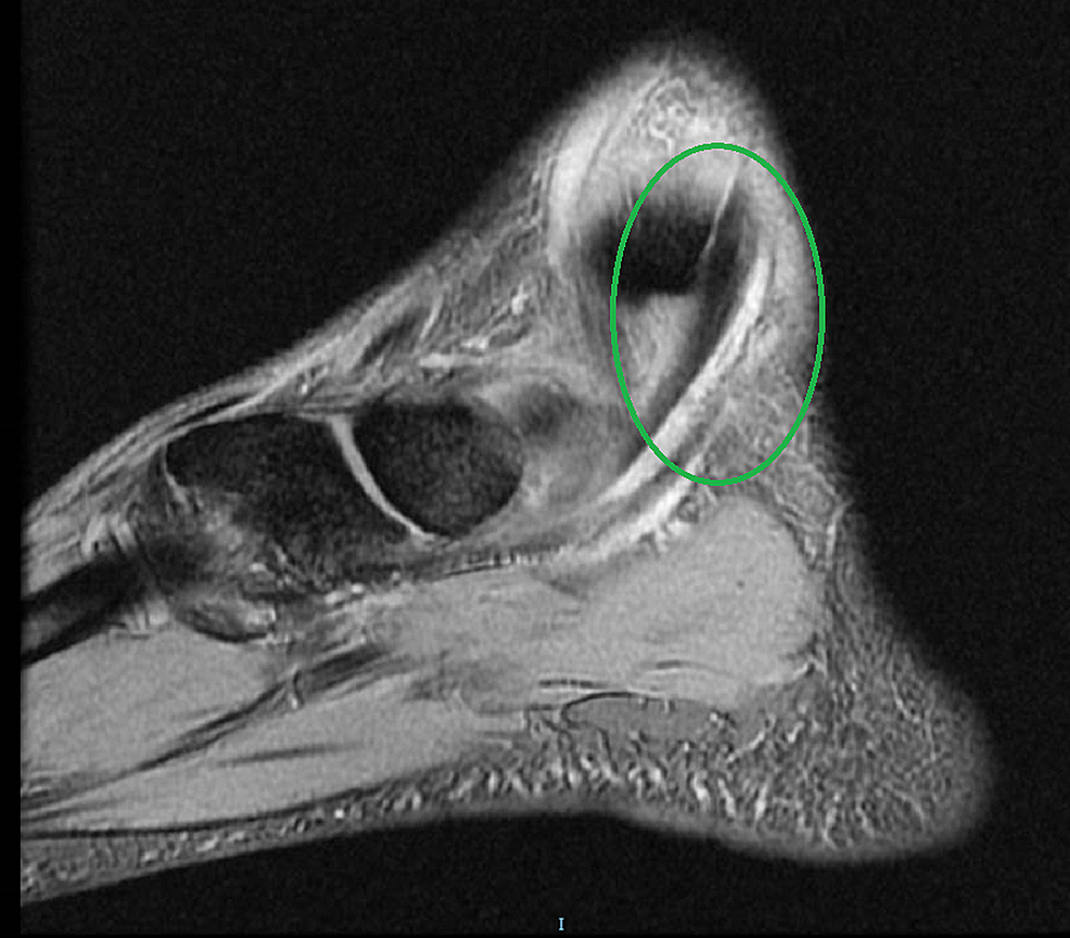 Posterior Tibial Tendonitis Mri Porn Sex Picture 9429