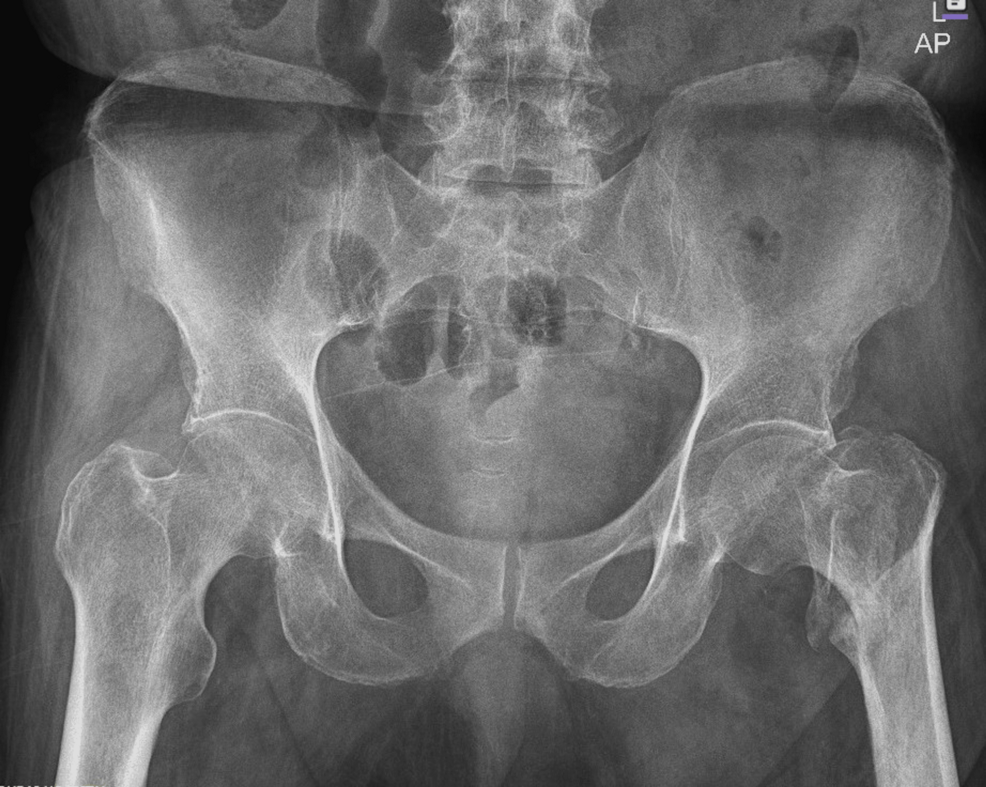 X-ray-pelvis-showing-the-mildly-displaced-intertrochanteric-fracture-of-the-left-femur.