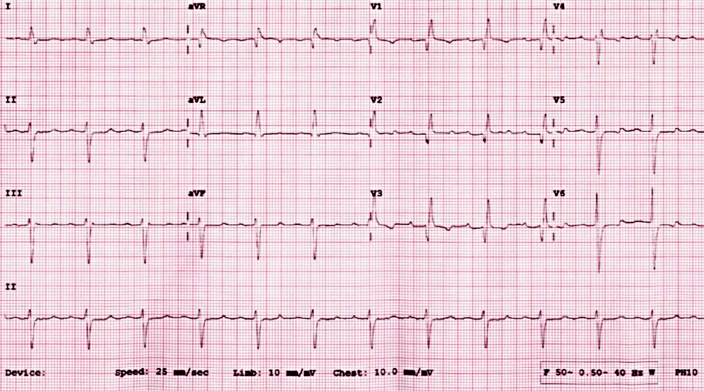 ECG-showing-the-sinus-rhythm-with-the-right-bundle-branch-block.