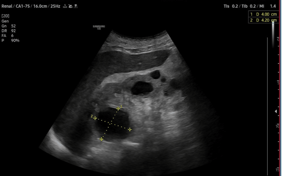 Renal-ultrasound-images-showing-renal-cortical-cysts.