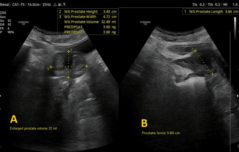 Pelvis-ultrasound-images-showing-an-enlarged-prostate.