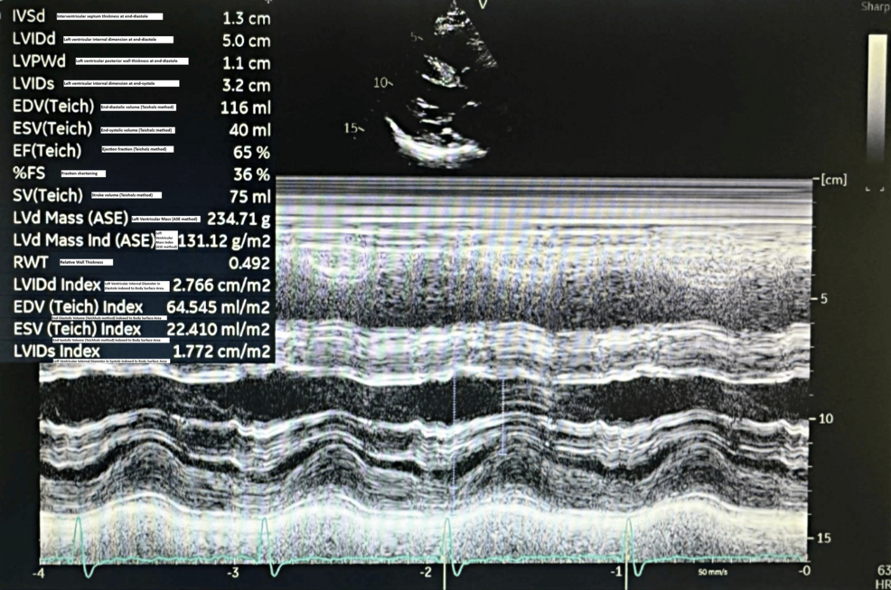 Transthoracic-echocardiogram-visualizing-the-normal-left-ventricular-function-and-structure.