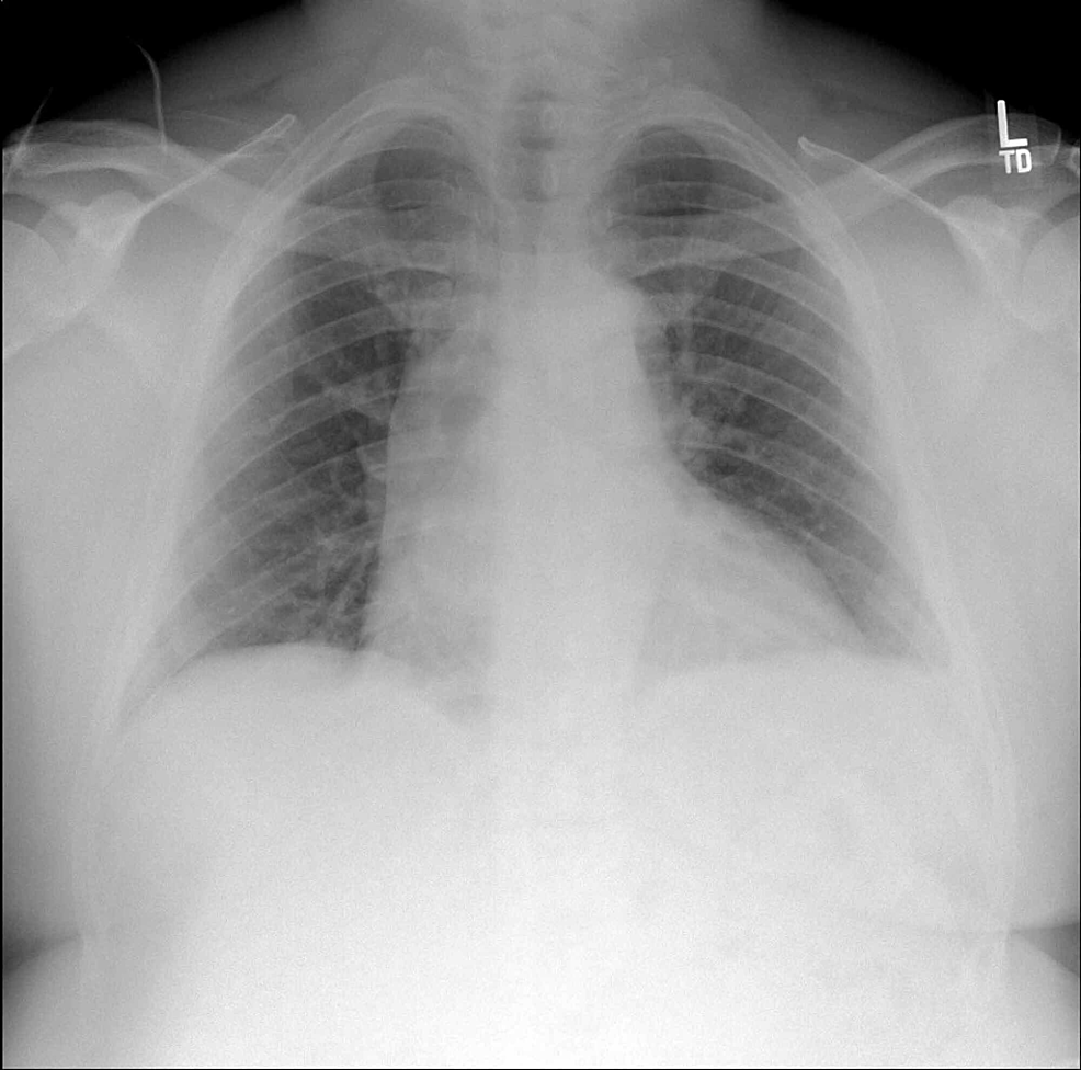 Cureus | Spodick’s Sign: A Case Report and Review of Literature