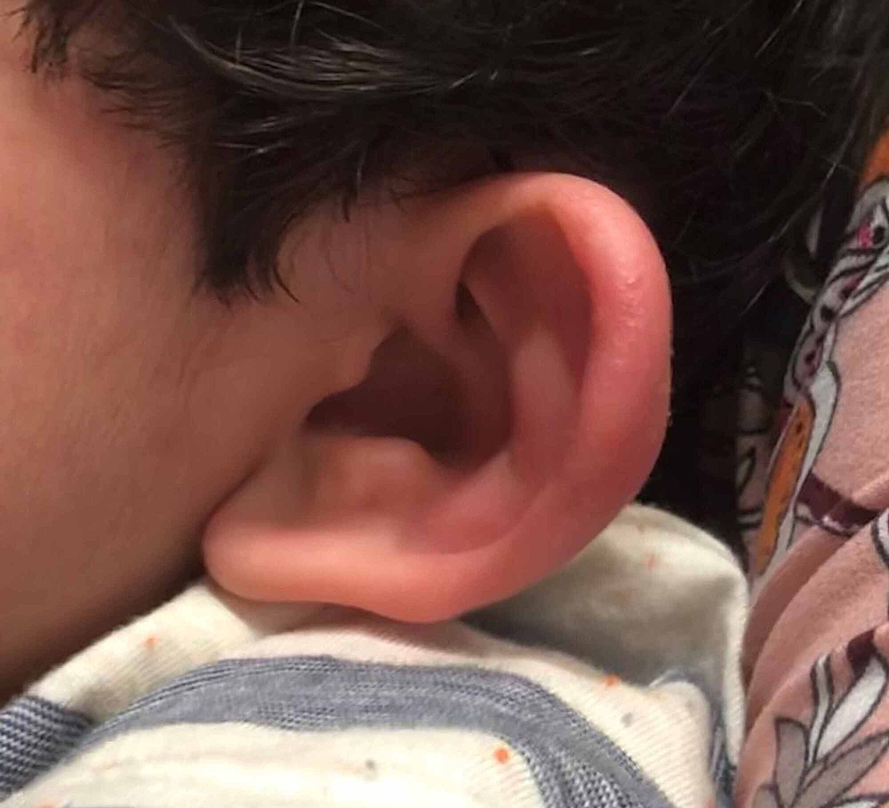 Cureus Perichondritis Not All Ear Pain Is Otitis