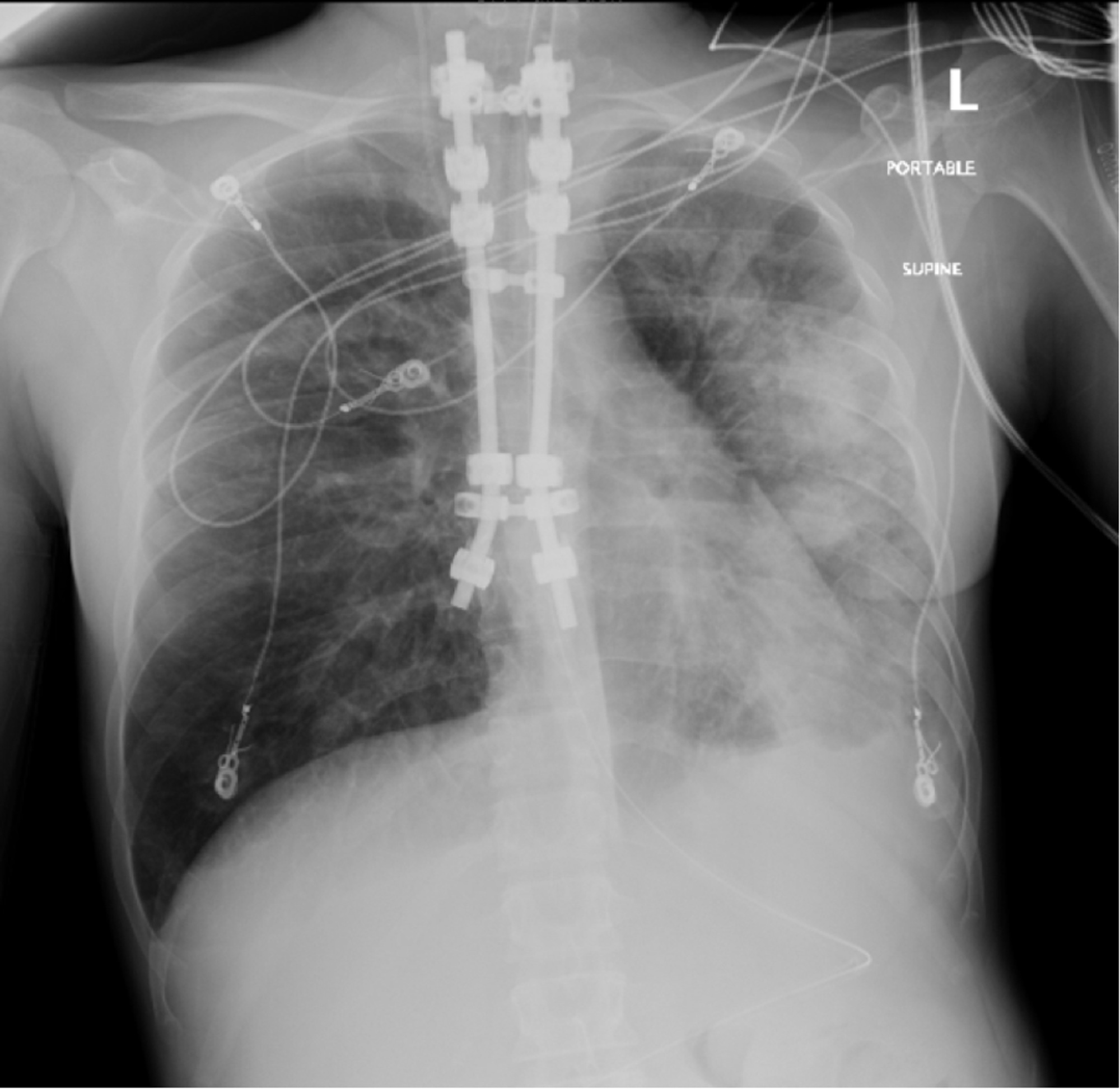 Cureus Acute Hypoxic Respiratory Failure And Septic Shock Secondary To Mycoplasma Pneumoniae Pneumonia Complicated By Heroin Overdose