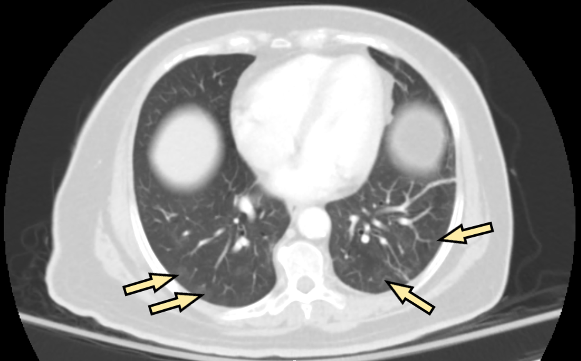 mesothelioma-google