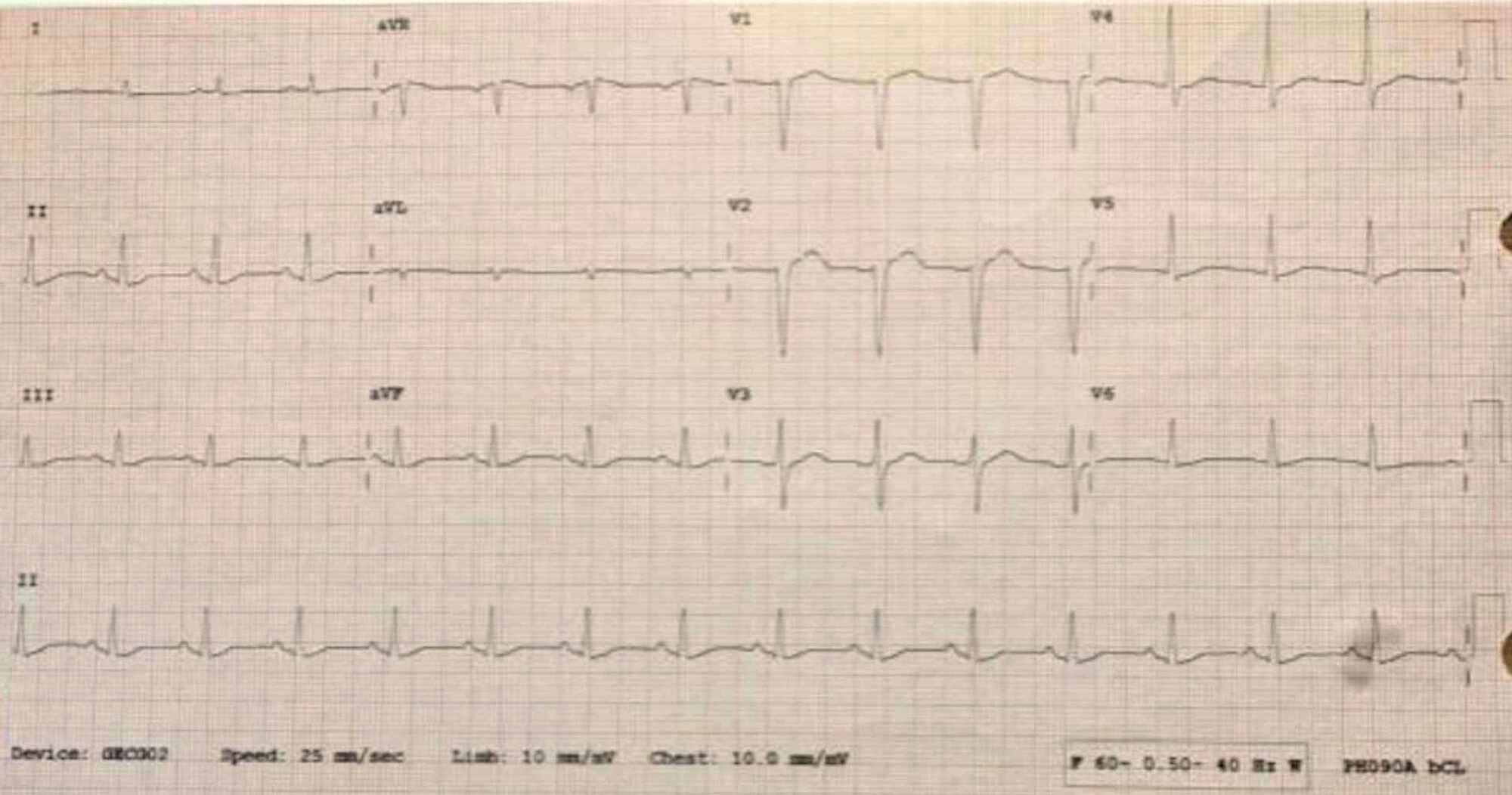 Cureus A Case of Trazodone Overdose Successfully Rescued With Lipid