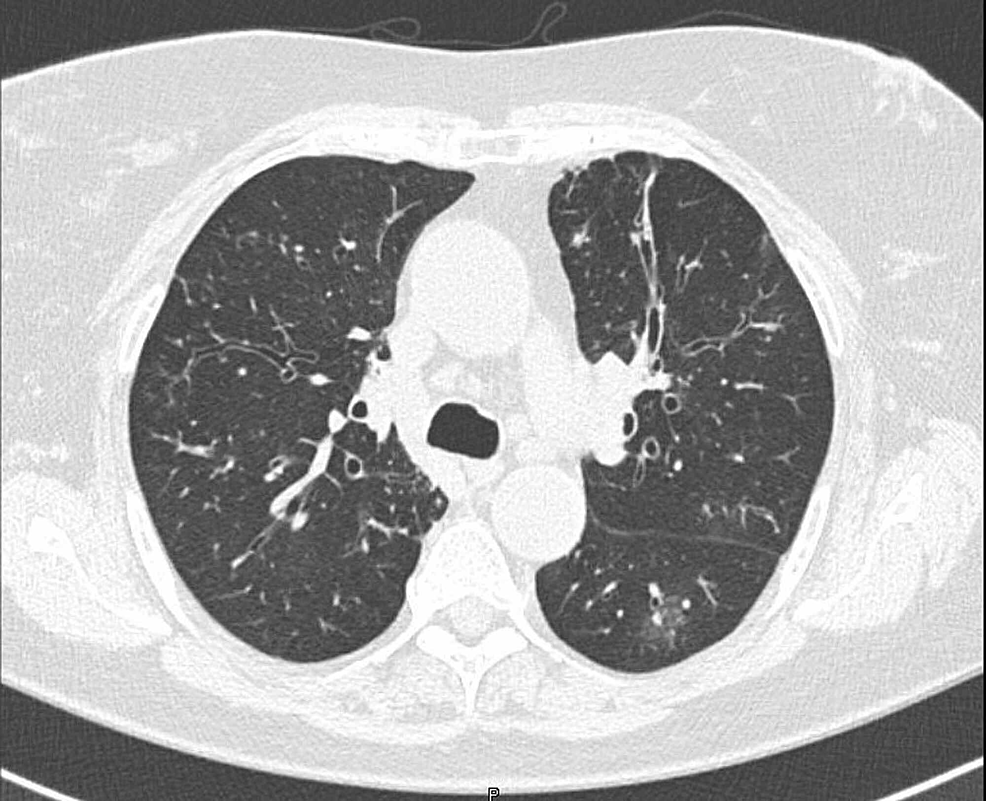 CT-chest-of-the-patient-taken-in-August-2019-at-Upstate-Medical-University