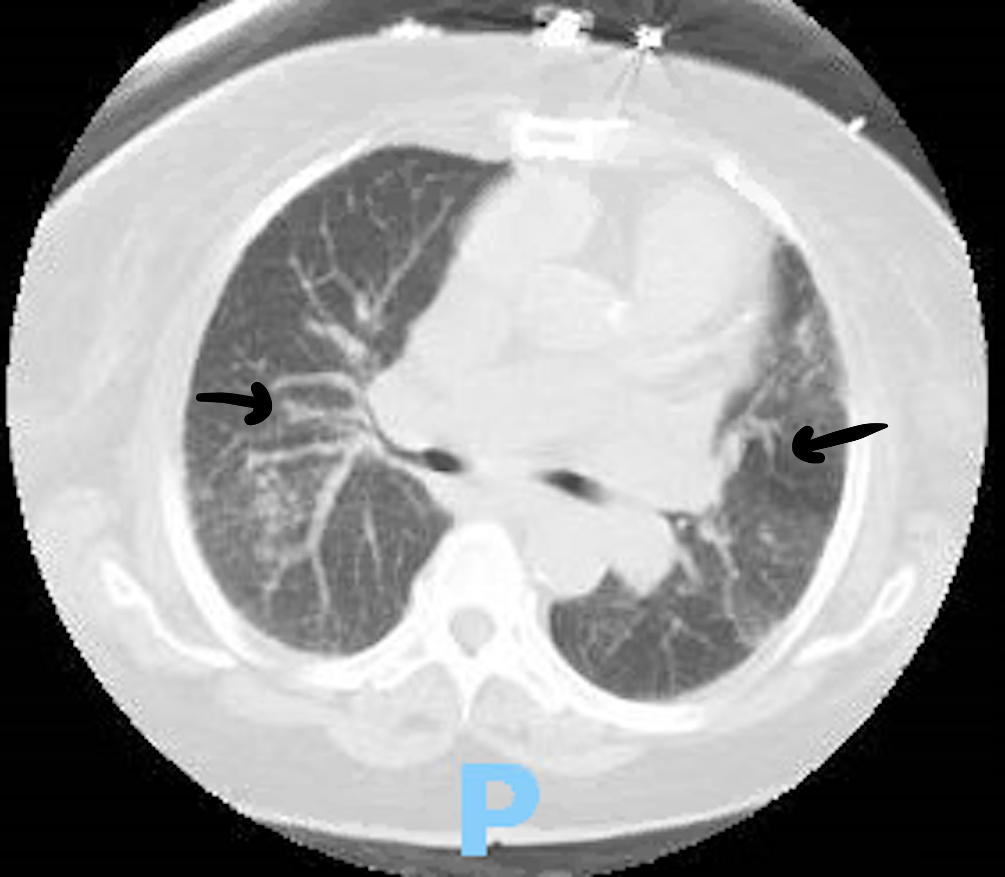 Cureus A Case Of Rheumatoid Arthritis Associated Interstitial Lung