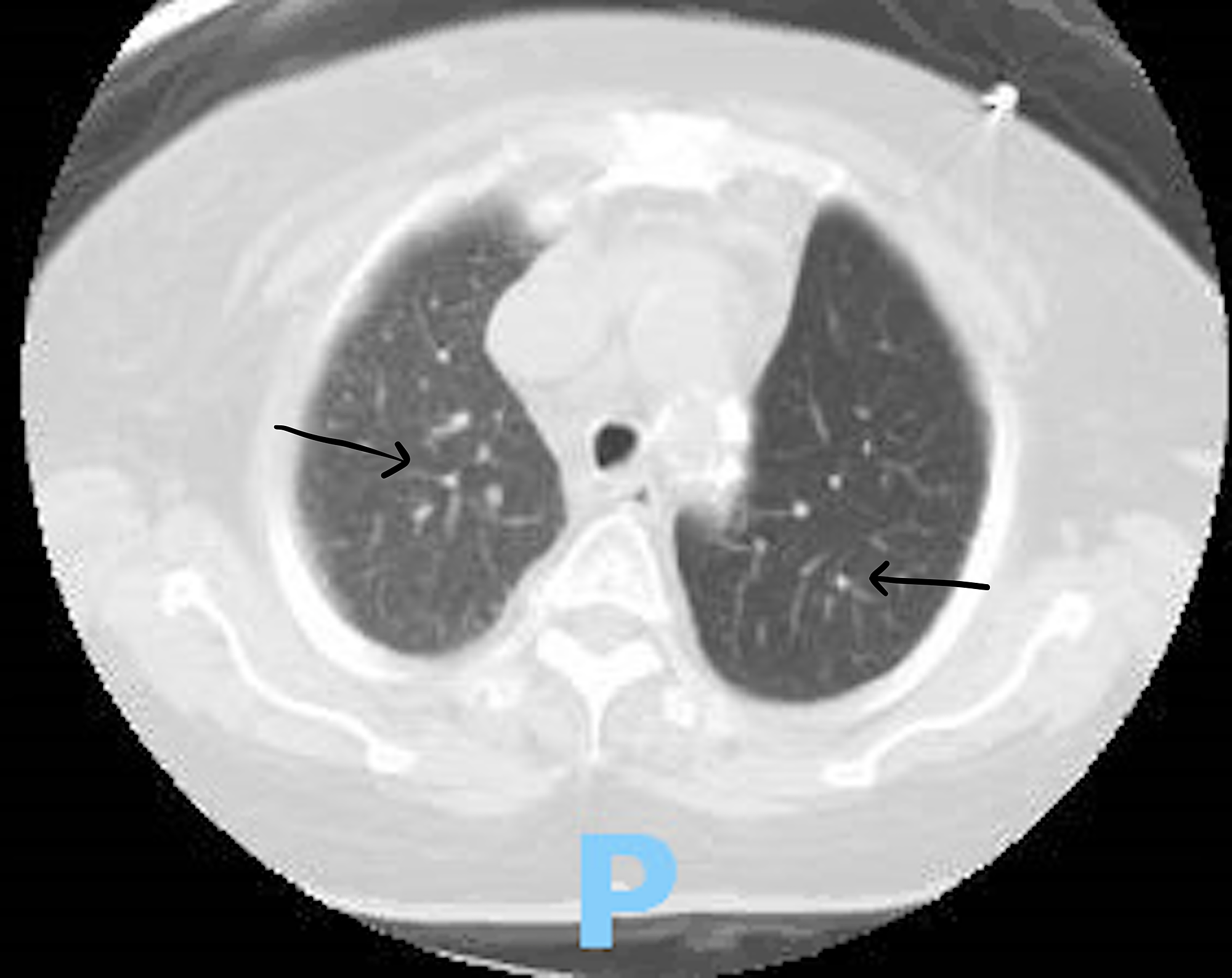 Cureus A Case of Rheumatoid ArthritisAssociated Interstitial Lung Disease An Unfortunate